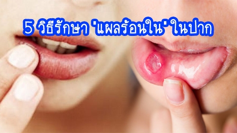 5 วิธีรักษา ''แผลร้อนใน'' ในปาก