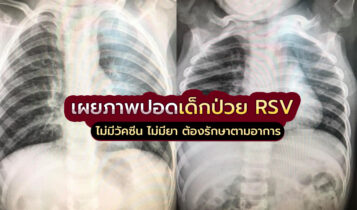 ภาพฟิล์มเอกซเรย์ปอดเด็กที่ติดเชื้อไวรัส RSV ไม่มียาต้องรักษาตามอาการ