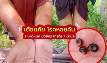 เตือนภัย โรคหอยคัน พบตัวอ่อนพยาธิไชเข้าผิวหนัง