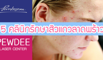 5 คลินิกรักษาสิวลาดพร้าว 2023 ราคาไม่แพง รักษาสิวหาย ไม่เลี้ยงไข้