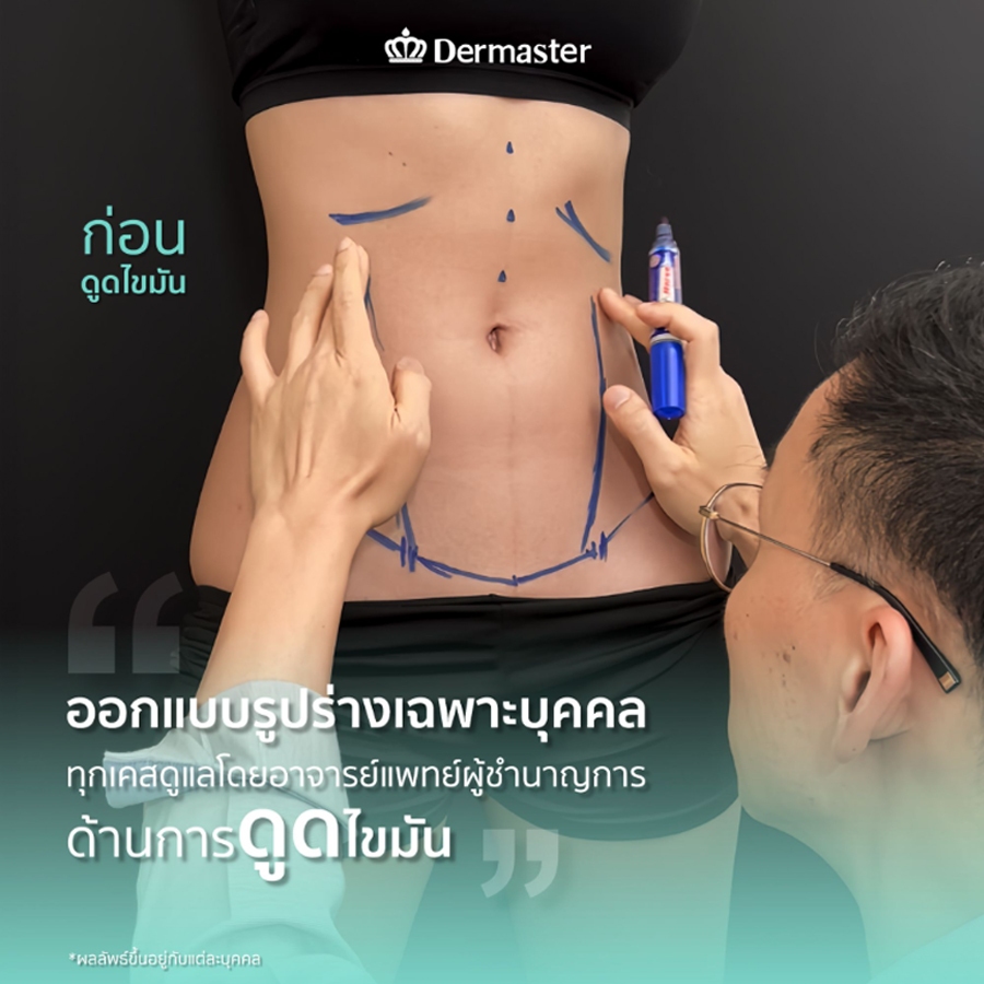 ดูดไขมันหน้าท้องอันตรายไหม