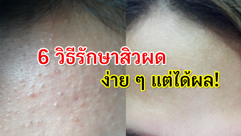 วิธีรักษาสิวผด แบบเร่งด่วน