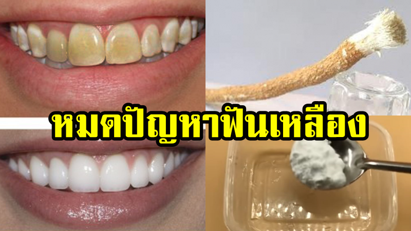 วิธีแก้ฟันเหลือง