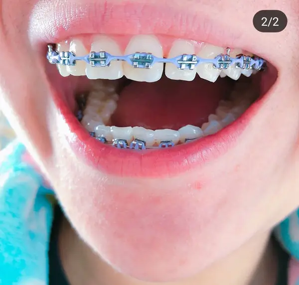 อัปเดต สียางจัดฟันใส่แล้วสวยปี 2022 พร้อมทริคเลือกสียางจัดฟัน